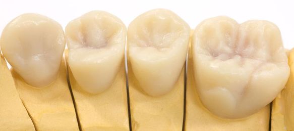 Modellierte Zähne für den Ersatz.