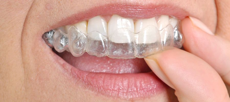Einsetzen einer unsichtbaren Zahnspange eines Patienten
